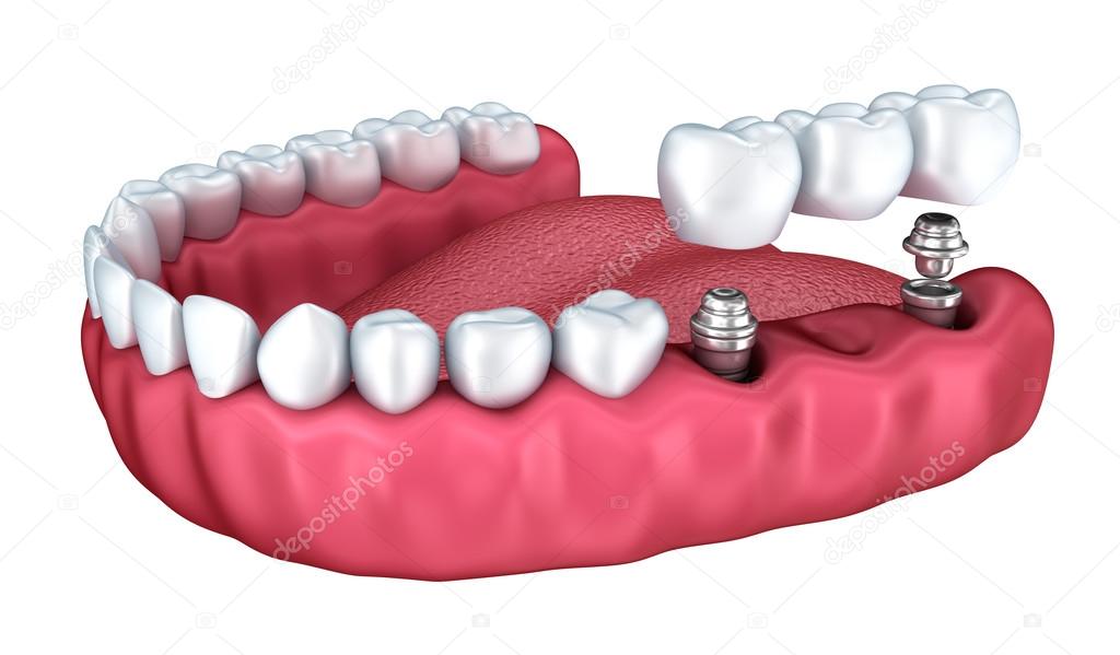 Ilustración de puente dental soportado por implantes