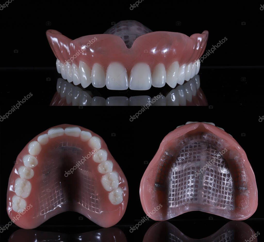 Prótesis completa fija sobre implantes en arcada superior