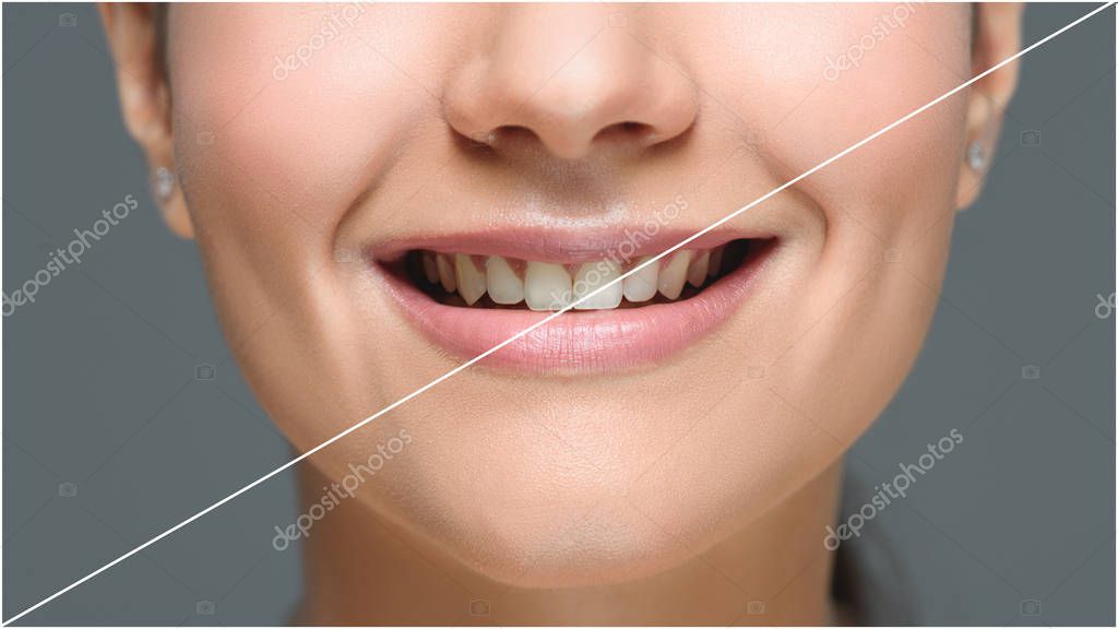 Comparación visual de sonrisa antes y después de colocar carillas