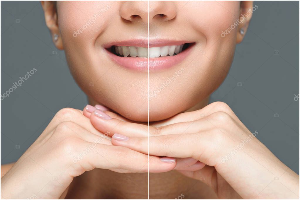 Comparación de sonrisa antes y después de tratamiento estético dental